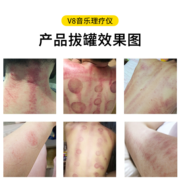 V8音樂理療儀拔罐效果圖